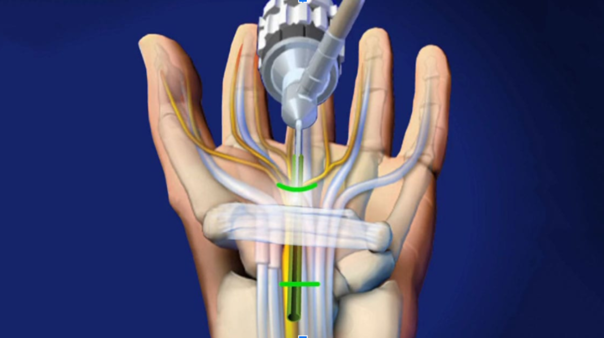  Hand Wrist and Upper Limb Surgery in Hyderabad